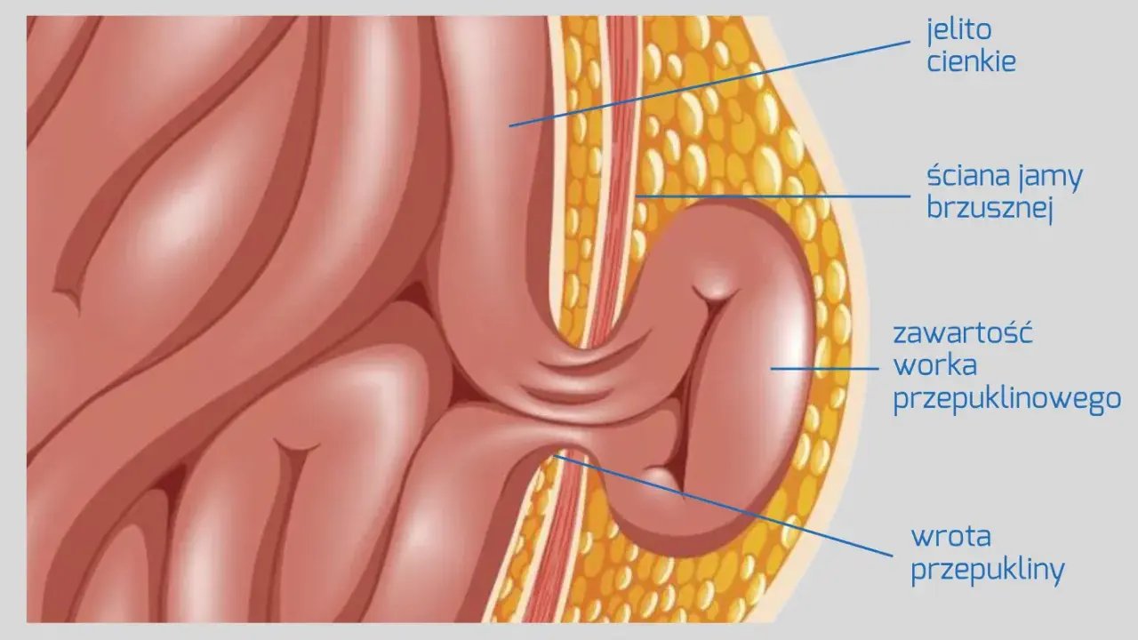 Anatomia przepukliny od dźwigania: jelito cienkie przechodzi przez ścianę jamy brzusznej, tworząc worek przepuklinowy.