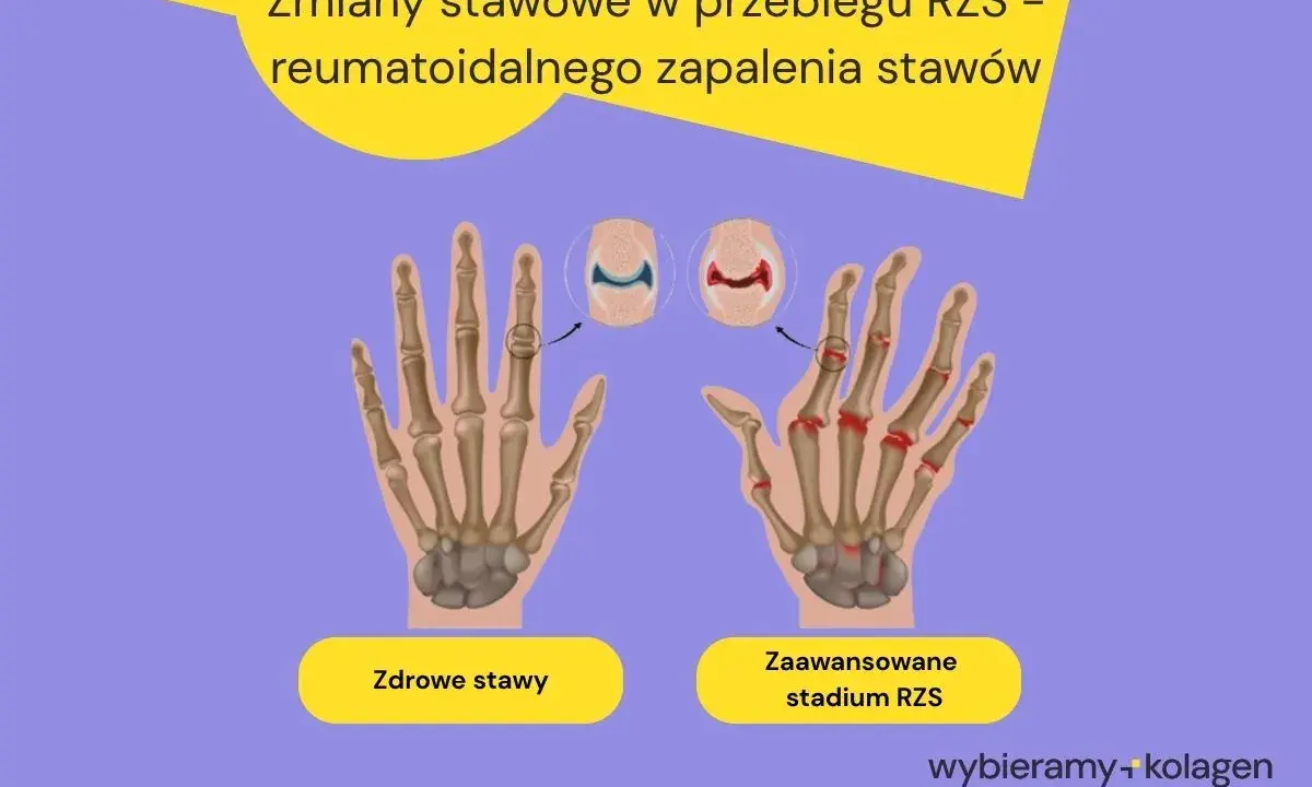 Porównanie zdrowych stawów dłoni z zaawansowanym stadium RZS, pokazujące zmiany zapalne. RZS pierwsze objawy mogą być subtelne.