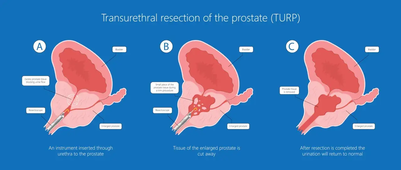Ilustracja pokazuje przebieg resekcji przezcewkowej prostaty (TURP). Po zabiegu rekonwalescencja po operacji prostaty TURP pozwala na powrót do normalnego oddawania moczu.
