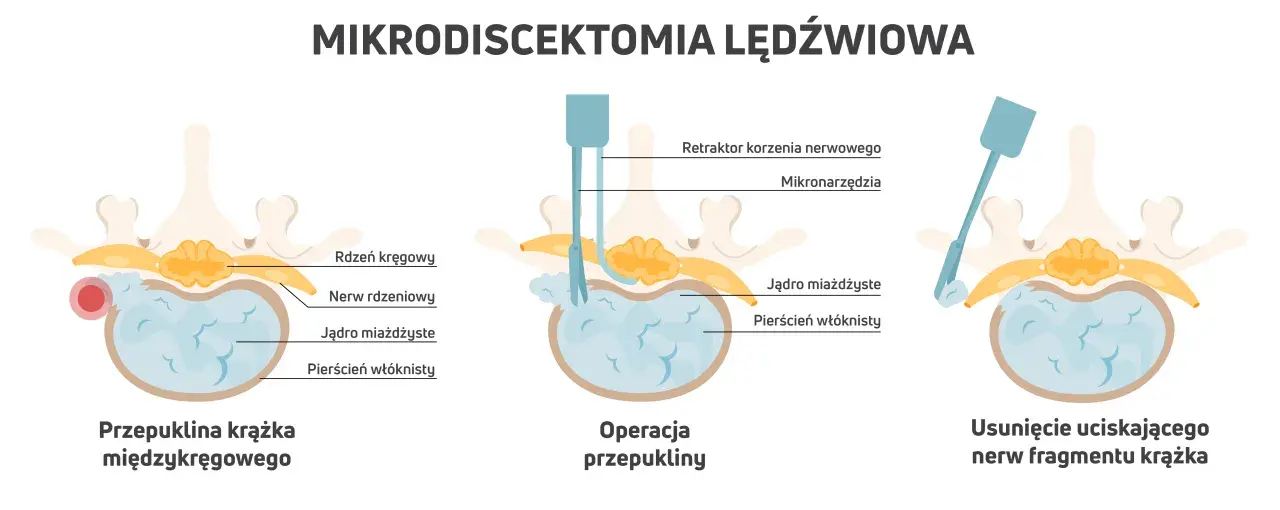 Ilustracja pokazuje mikrodyscektomię lędźwiową: przepuklinę krążka, operację i usunięcie fragmentu krążka. To jedne z zabiegów na przepuklinę kręgosłupa lędźwiowego.