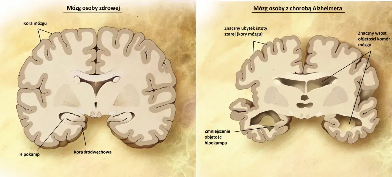 Porównanie mózgu zdrowego i z chorobą Alzheimera. Widać ubytek kory mózgowej i hipokampa, co pokazuje, jak alzheimer ile się żyje, zmienia mózg.