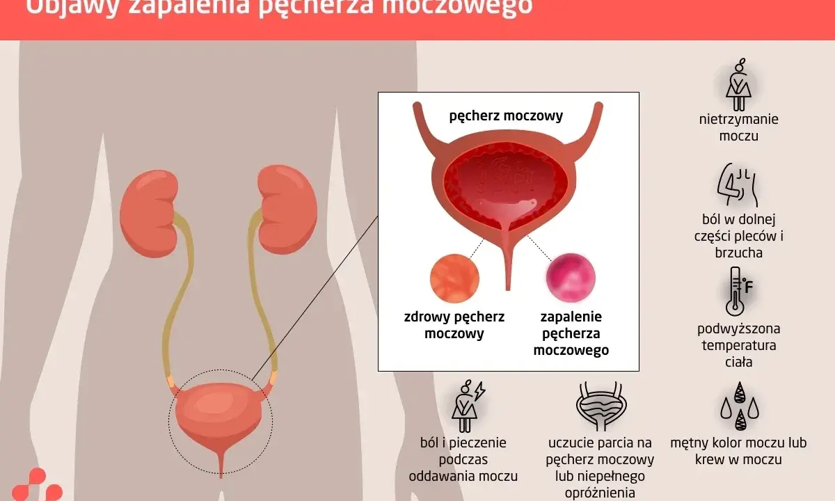Ból i pieczenie przy oddawaniu moczu to jeden z objawów zapalenia pęcherza. Grafika pokazuje układ moczowy i objawy infekcji.