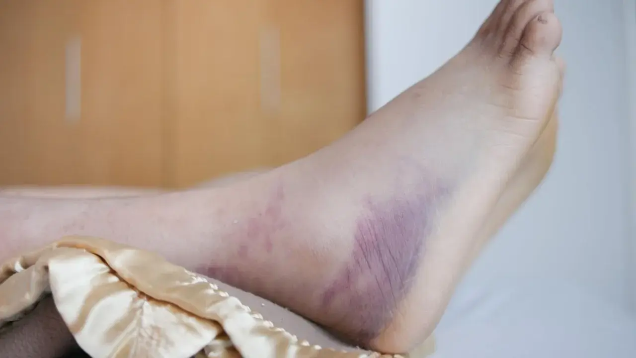 Stopa z widocznymi sinymi przebarwieniami, które mogą być objawem rany cukrzycowej.