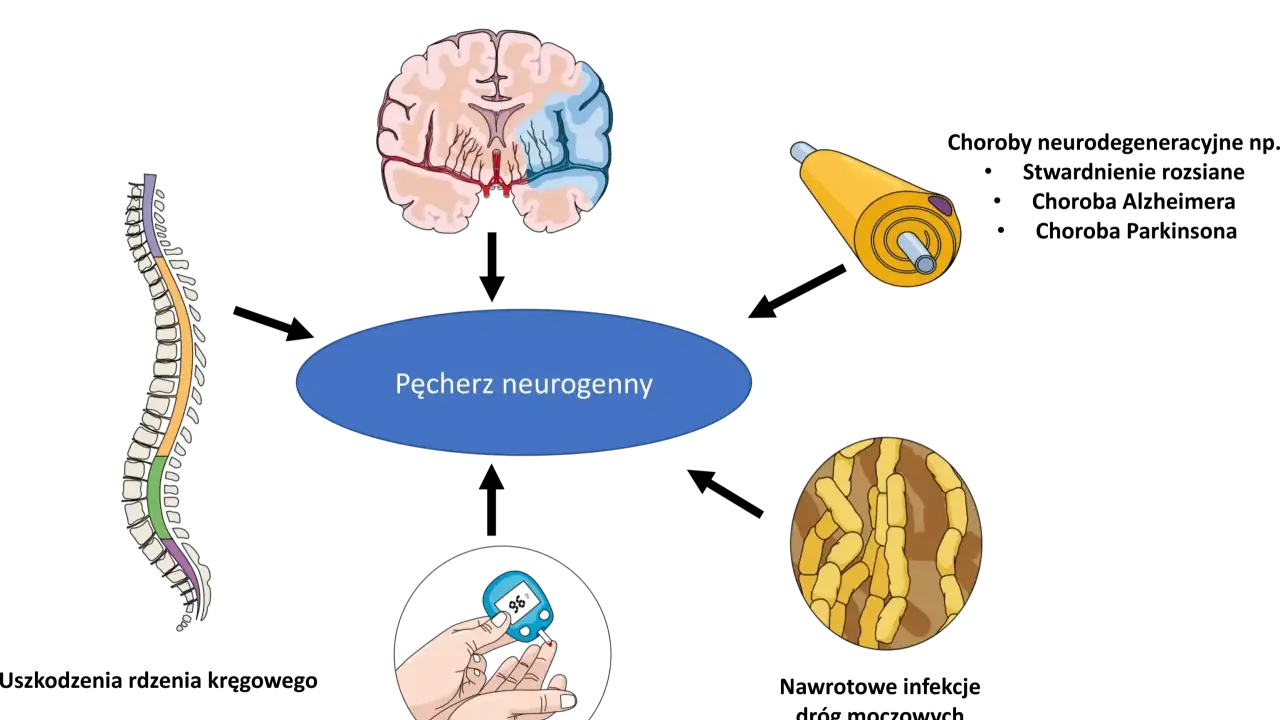 Ilustracja przedstawia mózg, rdzeń kręgowy, neuron i glukometr, sugerując, czy pęcherz neurogenny da się wyleczyć.
