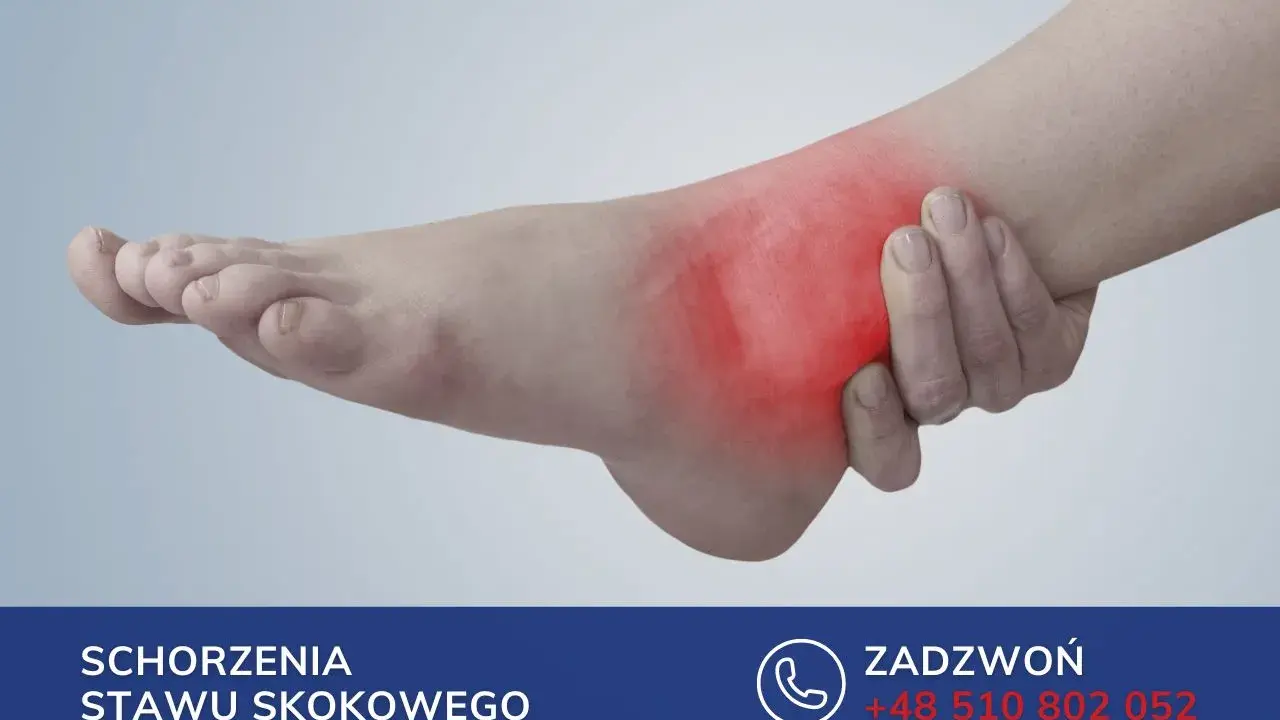 Obrzęk po złamaniu kostki może utrzymywać się długo. Zobacz, jak długo puchnie noga po złamaniu kostki i jak uzyskać pomoc.