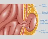 Anatomia przepukliny od dźwigania: jelito cienkie przechodzi przez ścianę jamy brzusznej, tworząc worek przepuklinowy.