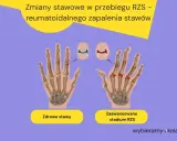 Porównanie zdrowych stawów dłoni z zaawansowanym stadium RZS, pokazujące zmiany zapalne. RZS pierwsze objawy mogą być subtelne.