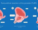 Ilustracja pokazuje przebieg resekcji przezcewkowej prostaty (TURP). Po zabiegu rekonwalescencja po operacji prostaty TURP pozwala na powrót do normalnego oddawania moczu.
