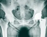 RTG miednicy z widoczną endoprotezą stawu biodrowego. Test na obluzowanie endoprotezy stawu biodrowego.