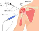 Endoproteza barku NFZ - Jak uniknąć pułapek i dopłat?