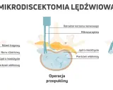 Ilustracja pokazuje mikrodyscektomię lędźwiową: przepuklinę krążka, operację i usunięcie fragmentu krążka. To jedne z zabiegów na przepuklinę kręgosłupa lędźwiowego.