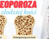 Osteoporoza pomenopauzalna: porównanie zdrowej i osteoporotycznej kości. Szkielet z zaznaczonym bólem w obrębie barku.