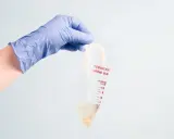 Ręka w niebieskiej rękawiczce trzyma woreczek na mocz dla dziewczynki. Woreczek jest przezroczysty, z podziałką i napisem "Pediatric Urine Bag".