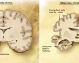 Porównanie mózgu zdrowego i z chorobą Alzheimera. Widać ubytek kory mózgowej i hipokampa, co pokazuje, jak alzheimer ile się żyje, zmienia mózg.