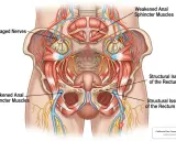 Anatomia miednicy z zaznaczonymi osłabionymi zwieraczami odbytu i uszkodzonymi nerwami. Rozważ leki na wzmocnienie zwieraczy odbytu.