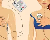 Instrukcja użycia AED skrót: elektrody przyklejone do klatki piersiowej, gotowe do użycia.