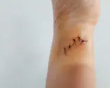 Zbliżenie na źle zszytą ranę na skórze, z widocznymi szwami i zaczerwienieniem.