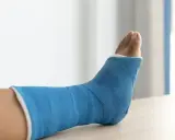 Niebieski gips na nodze po złamaniu trójkostkowym. Czekam na moment, kiedy będę mógł chodzić.