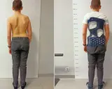 Chłopiec w gorsecie na kręgosłup, korygującym wadę postawy. Widoczna poprawa sylwetki.