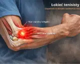 Anatomia łokcia z widocznym stanem zapalnym ścięgien i bólem, ilustracja problemu nieleczonego łokcia tenisisty.