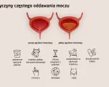 Ilustracja pokazuje przyczyny częstego oddawania moczu, w tym problemy z kręgosłupem lędźwiowym, które mogą wpływać na pęcherz.