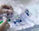 Rękawiczka medyczna przygotowuje żel lubrykujący do cewnikowania. Czy zakładanie cewnika boli? Zależy od wielu czynników, ale odpowiednie przygotowanie minimalizuje dyskomfort.