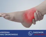Obrzęk po złamaniu kostki może utrzymywać się długo. Zobacz, jak długo puchnie noga po złamaniu kostki i jak uzyskać pomoc.