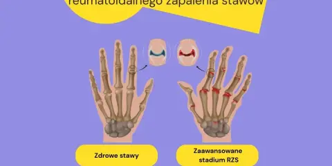 Porównanie zdrowych stawów dłoni z zaawansowanym stadium RZS, pokazujące zmiany zapalne. RZS pierwsze objawy mogą być subtelne.