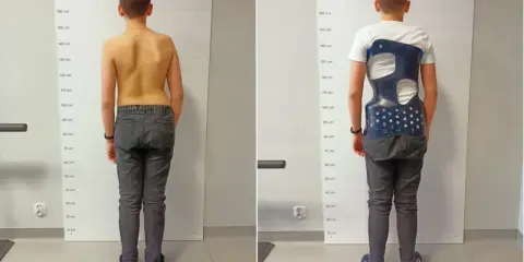 Chłopiec w gorsecie na kręgosłup, korygującym wadę postawy. Widoczna poprawa sylwetki.