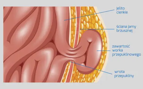 Anatomia przepukliny od dźwigania: jelito cienkie przechodzi przez ścianę jamy brzusznej, tworząc worek przepuklinowy.