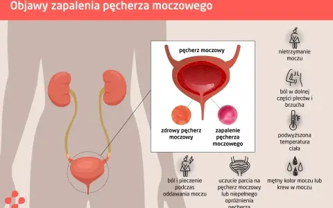 Ilustracja przedstawia objawy zapalenia dróg moczowych: ból, pieczenie, nietrzymanie moczu, gorączkę, ból brzucha i pleców, mętny mocz.