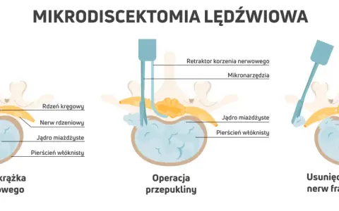 Ilustracja pokazuje mikrodyscektomię lędźwiową: przepuklinę krążka, operację i usunięcie fragmentu krążka. To jedne z zabiegów na przepuklinę kręgosłupa lędźwiowego.