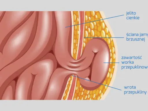 Anatomia przepukliny od dźwigania: jelito cienkie przechodzi przez ścianę jamy brzusznej, tworząc worek przepuklinowy.