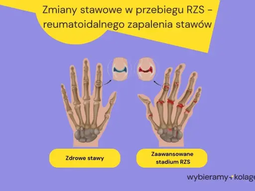 Porównanie zdrowych stawów dłoni z zaawansowanym stadium RZS, pokazujące zmiany zapalne. RZS pierwsze objawy mogą być subtelne.