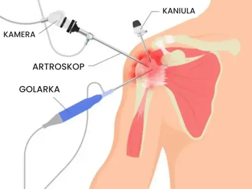 Endoproteza barku NFZ - Jak uniknąć pułapek i dopłat?