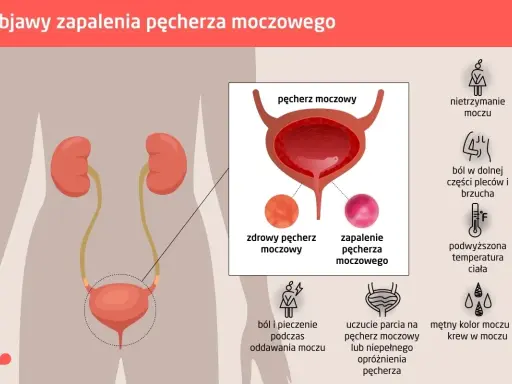 Ilustracja przedstawia objawy zapalenia dróg moczowych: ból, pieczenie, nietrzymanie moczu, gorączkę, ból brzucha i pleców, mętny mocz.