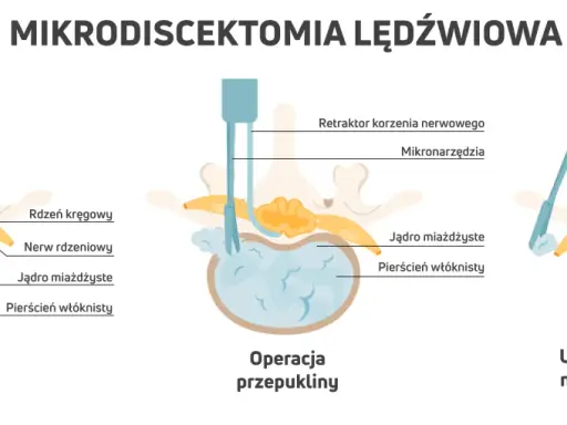 Ilustracja pokazuje mikrodyscektomię lędźwiową: przepuklinę krążka, operację i usunięcie fragmentu krążka. To jedne z zabiegów na przepuklinę kręgosłupa lędźwiowego.