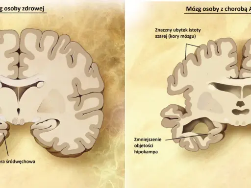 Porównanie mózgu zdrowego i z chorobą Alzheimera. Widać ubytek kory mózgowej i hipokampa, co pokazuje, jak alzheimer ile się żyje, zmienia mózg.