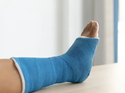 Niebieski gips na nodze po złamaniu trójkostkowym. Czekam na moment, kiedy będę mógł chodzić.