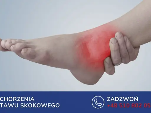 Obrzęk po złamaniu kostki może utrzymywać się długo. Zobacz, jak długo puchnie noga po złamaniu kostki i jak uzyskać pomoc.