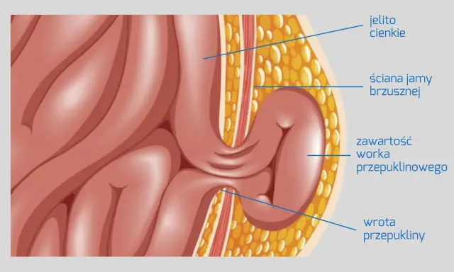 Anatomia przepukliny od dźwigania: jelito cienkie przechodzi przez ścianę jamy brzusznej, tworząc worek przepuklinowy.