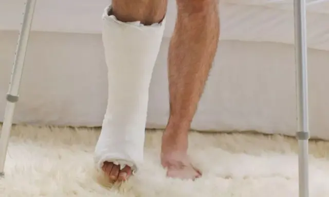 Noga w gipsie i zdrowa noga obok, przygotowanie do rehabilitacji po zdjęciu gipsu.