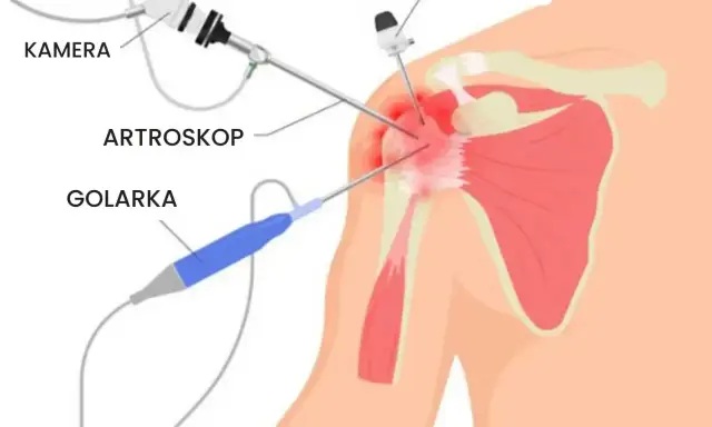Endoproteza barku NFZ - Jak uniknąć pułapek i dopłat?