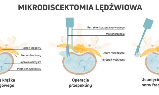 Ilustracja pokazuje mikrodyscektomię lędźwiową: przepuklinę krążka, operację i usunięcie fragmentu krążka. To jedne z zabiegów na przepuklinę kręgosłupa lędźwiowego.