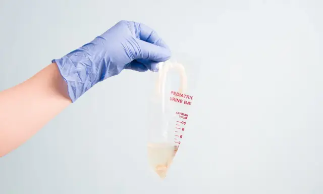 Ręka w niebieskiej rękawiczce trzyma woreczek na mocz dla dziewczynki. Woreczek jest przezroczysty, z podziałką i napisem "Pediatric Urine Bag".