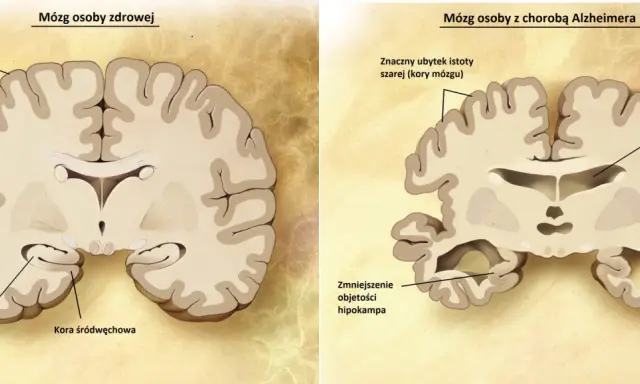 Porównanie mózgu zdrowego i z chorobą Alzheimera. Widać ubytek kory mózgowej i hipokampa, co pokazuje, jak alzheimer ile się żyje, zmienia mózg.