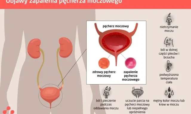 Ból i pieczenie przy oddawaniu moczu to jeden z objawów zapalenia pęcherza. Grafika pokazuje układ moczowy i objawy infekcji.