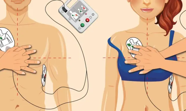 Instrukcja użycia AED skrót: elektrody przyklejone do klatki piersiowej, gotowe do użycia.