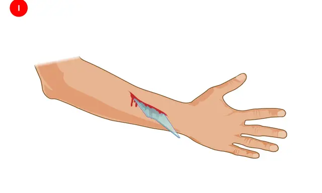 Ręka z raną ciętą i wbitym szkłem. Wskazówka dotycząca środków ochrony indywidualnej.