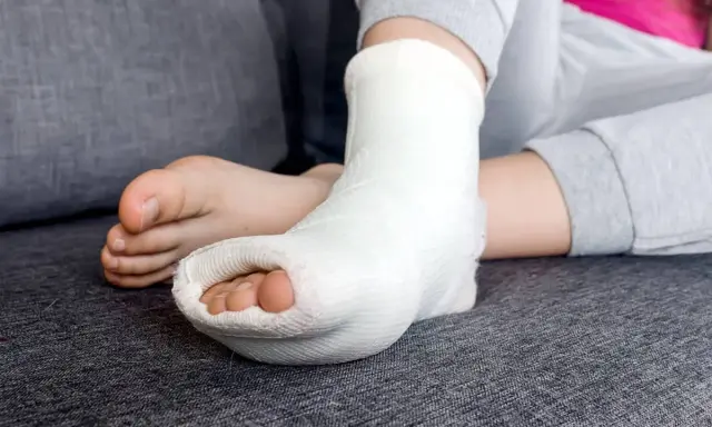 Dziecko z krzywą ręką po zdjęciu gipsu, z palcami stopy wystającymi z białego opatrunku.